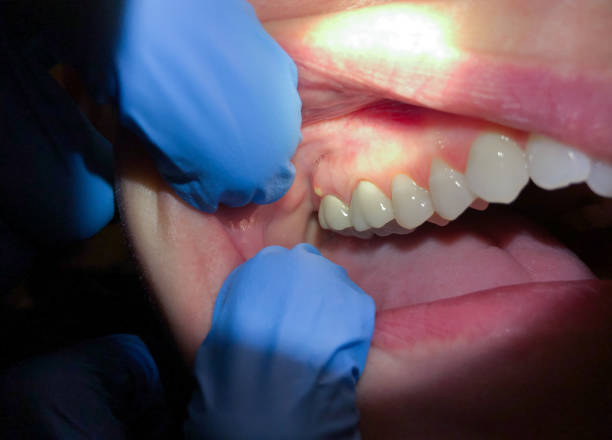 Best Broken Tooth Emergency  in Oberlin, LA