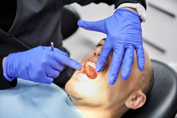 Best Chipped Tooth Repair Near Me  in Oberlin, LA