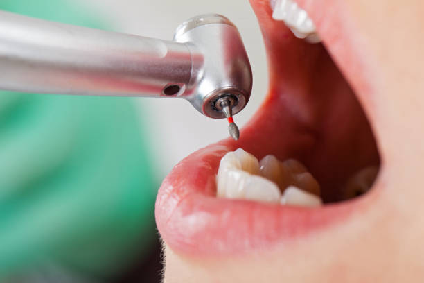 Best Root Canal Emergency Dentist  in Oberlin, LA